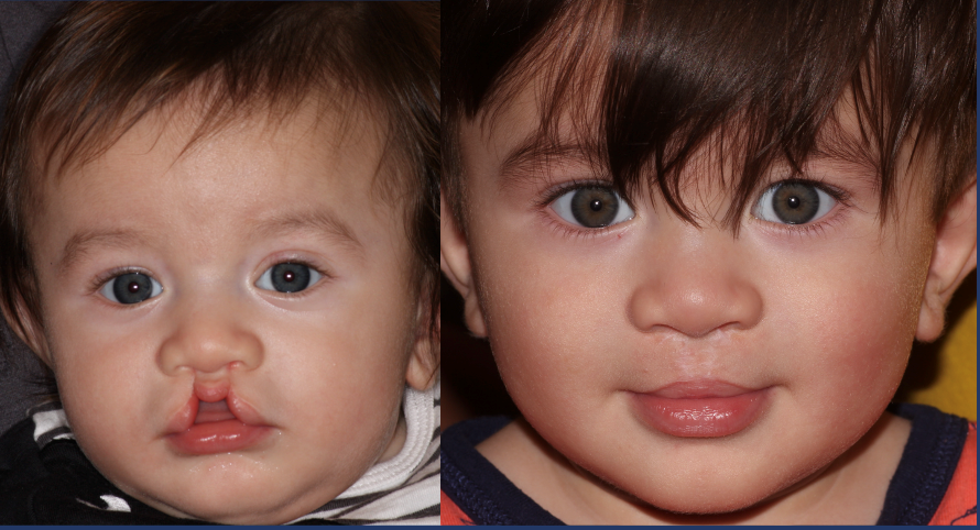 cleft lip before and after